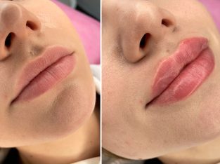 Контурирование губ в Соломенском районе — увлажнение и увеличение губ