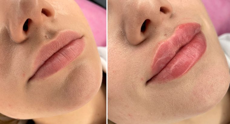 Контурирование губ в Соломенском районе — увлажнение и увеличение губ